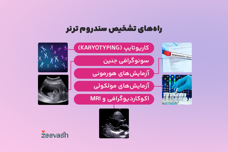 راه های تشخیص سندروم ترنر